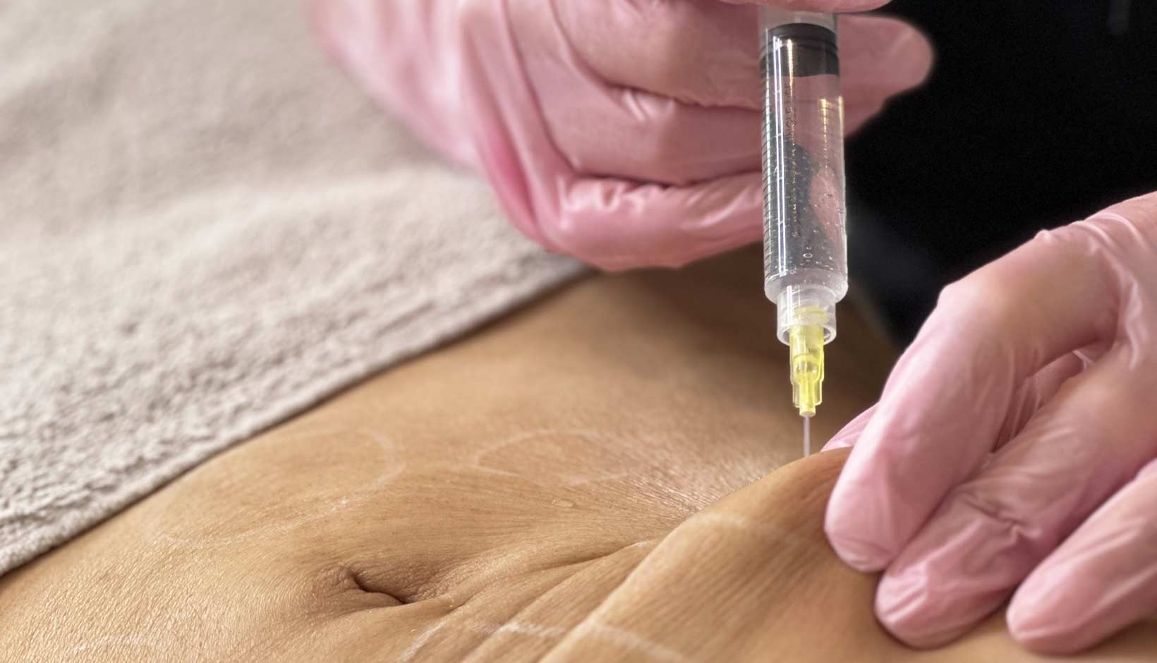 Hochwertige Filler bei MorySkin: juvderm für natürliche Ergebnisse