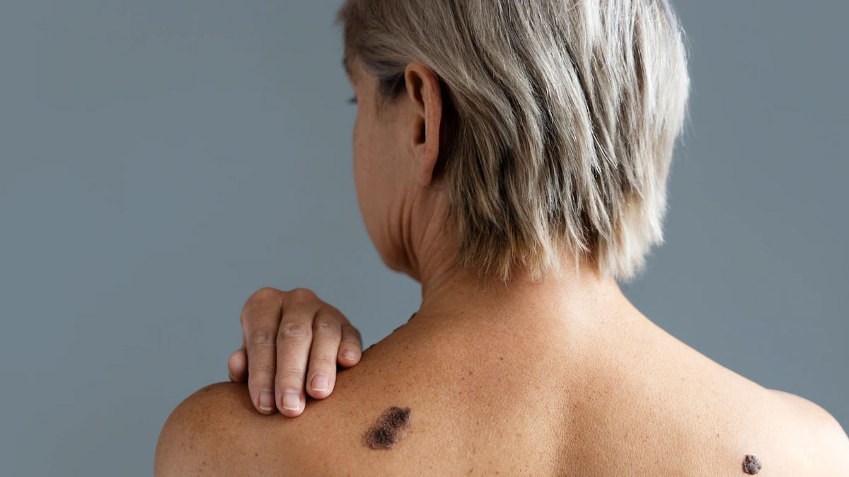 Tattooentfernung: Effektiv und schonend dank Laserbehandlung